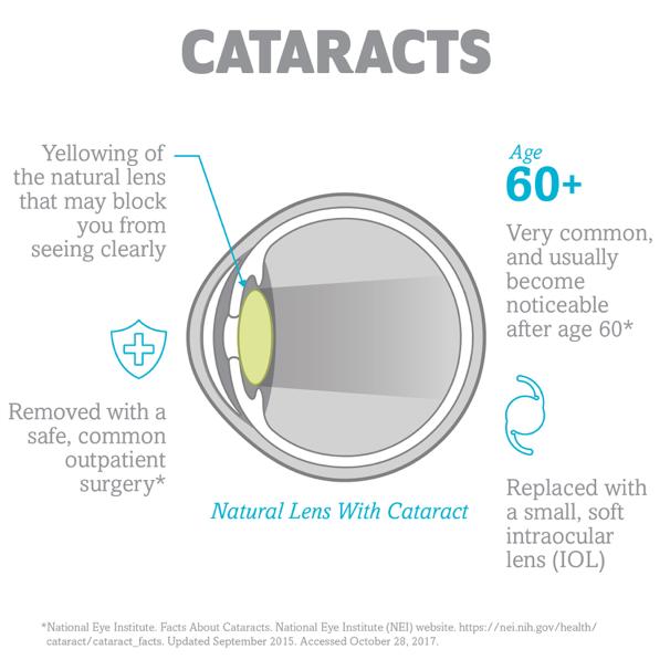 Visual of the eye showing how an intraocular lens (IOL) replaces the natural lens during cataract surgery