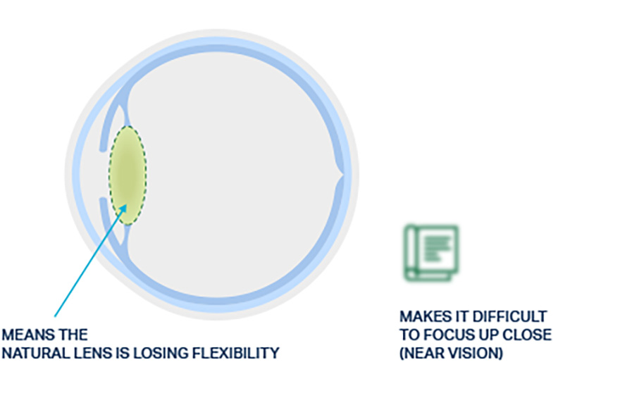 Visual of a natural eye lens with presbyopia