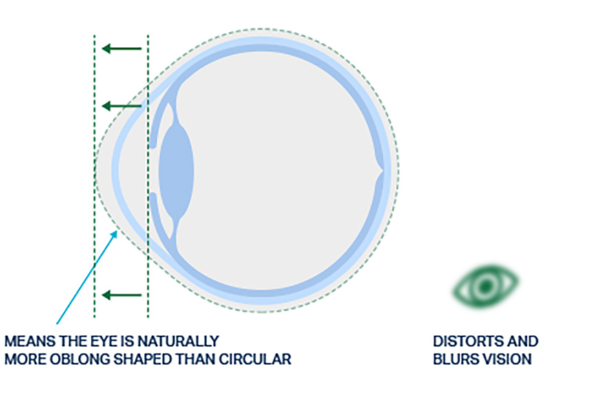 Visual showing eye shape with astigmatism